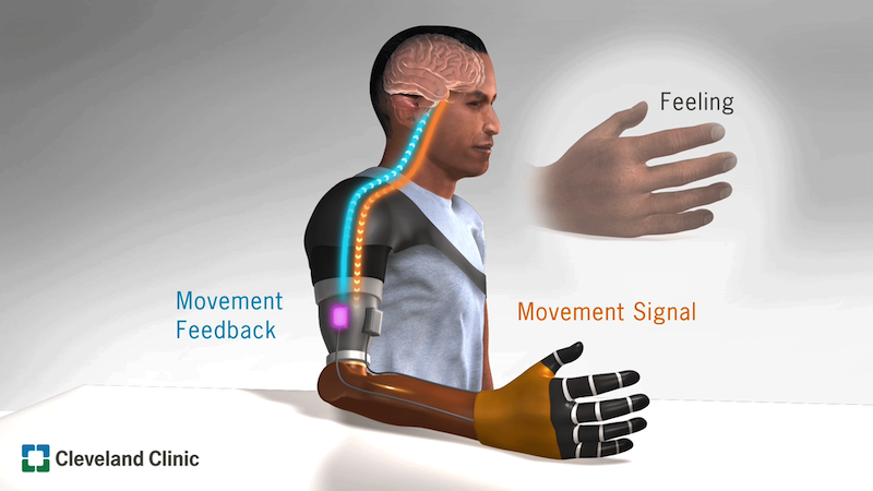 Cleveland Clinic develops bionic arm that restores 'natural